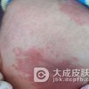怎样做好红胎记的预防工作