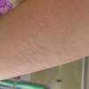 病毒性荨麻疹会有什么危害