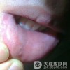 黏膜白斑有哪些临床特点