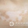 贫血痣的病因是什么?