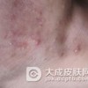 要怎么有效预防甲沟炎
