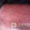 甲沟炎不同类型症状表现有哪些
