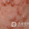 青春痘可能相互传染吗