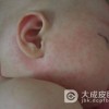 麻疹的护理