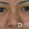 青春痘对患者有哪些影响
