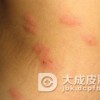 单纯痒疹的治疗方法有哪些