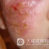 脓包疮怎么治疗呢