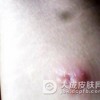 儿童最容易患有脓包疮
