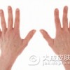 湿疹病患需要注意些什么