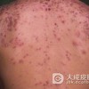 长了青春痘平时的注意事项