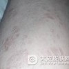 怎么预防副银屑病