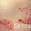 带状疱疹患者需注意什么