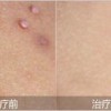 激光治疗寻常疣要有哪些要注意