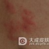 人们为什么容易患过敏性皮炎