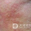 脂溢性皮炎常见危害
