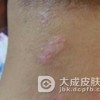 过敏性皮炎的预防事项该怎么做