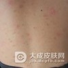 头部银屑病应该如何治愈