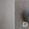 黑色素痣会造成哪些危害