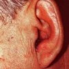 耳部带状疱疹的主要症状有哪些