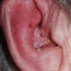 耳部患有带状疱疹应该注意哪些