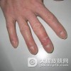 汗疱疹怎么治疗