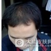 如何解决油性皮肤的脱发问题呢