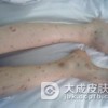 预防摩擦性苔癣样疹要采取什么方法