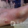 扁平苔癣通常会引起瘙痒症状