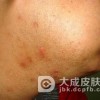 扁平苔藓的危害有哪些