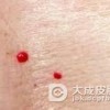 鲜红斑痣的出现病因是什么呢