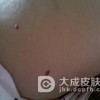 什么原因可导致鲜红斑痣