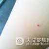 出现鲜红斑痣的原因是什么