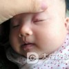 鲜红斑痣的病因是什么