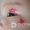 鲜红斑痣的危害主要有什么