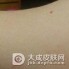 鲜红斑痣的危害是什么？