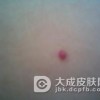 鲜红斑痣的危害