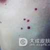 鲜红斑痣会不会遗传给孩子呢