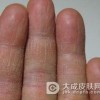 手癣会给我们带来哪些影响