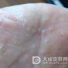 手癣是否会传染