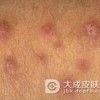 急性单纯性痒疹症状表现