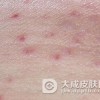 单纯性痒疹有哪些处理措施
