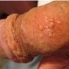 生殖器疱疹常见的表现