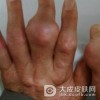 应该怎样预防痛风的发生呢