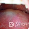外阴黏膜白斑有什么鉴别诊断