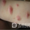 单纯性痒疹如何预防？