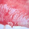 口腔黏膜白斑的发病特点