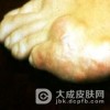 多吃黄花菜可以预防痛风吗