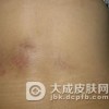 局限性硬皮病患者的护理措施都有哪些呢
