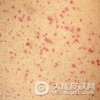 紫癜与过敏性紫癜的区别是什么样