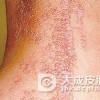 自体敏感性皮炎的发生原因有什么
